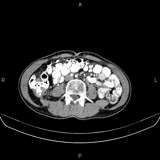 Colon adenocarcinoma - hepatic flexure (Radiopaedia 85635-101395 A 51).jpg