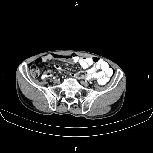 Colon adenocarcinoma - hepatic flexure (Radiopaedia 85635-101395 A 70).jpg