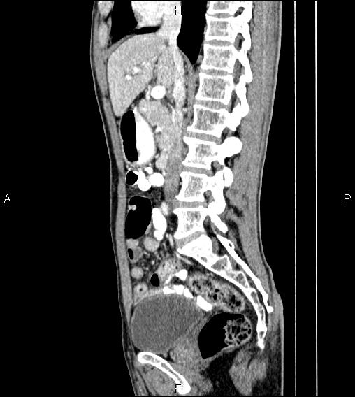 Colon adenocarcinoma - hepatic flexure (Radiopaedia 85635-101395 D 40).jpg