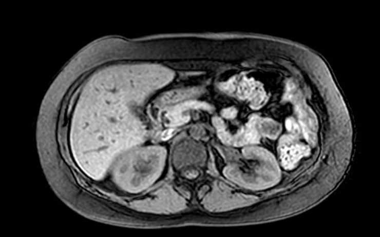 File:Colon adenocarcinoma with Krukenberg tumors, advanced pregnancy (Radiopaedia 67279-76645 A 57).jpg