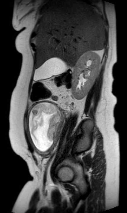Colon adenocarcinoma with Krukenberg tumors, advanced pregnancy (Radiopaedia 67279-76645 Sagittal T2 37).jpg