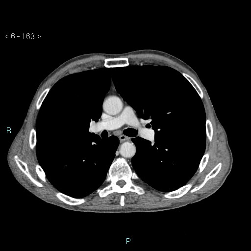 File:Colonic cancer (ultrasound and TC imaging) (Radiopaedia 50346-55713 B 163).jpg