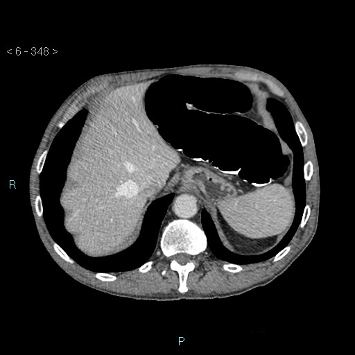 Colonic cancer (ultrasound and TC imaging) (Radiopaedia 50346-55713 B 348).jpg
