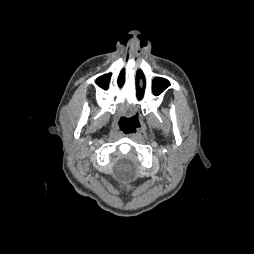 Nasal pyogenic granuloma (lobular capillary hemangioma) (Radiopaedia 85536-101244 C 8).jpg