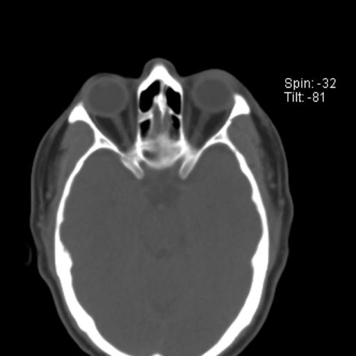 File:Nasolabial cyst (Radiopaedia 28401-28650 Axial bone window 7).jpg