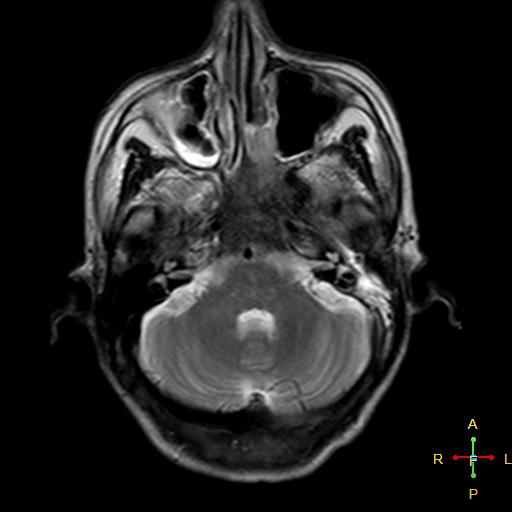File:Nasopharyngeal carcinoma infiltrating the clivus (Radiopaedia 25229-25481 Axial T2 6).jpg
