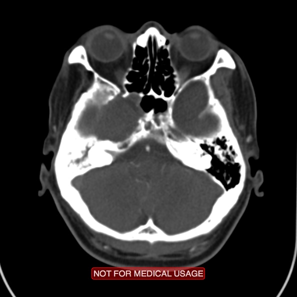 File:Nasopharyngeal carcinoma recurrence - skull base destruction (Radiopaedia 29107-29491 A 5).jpg