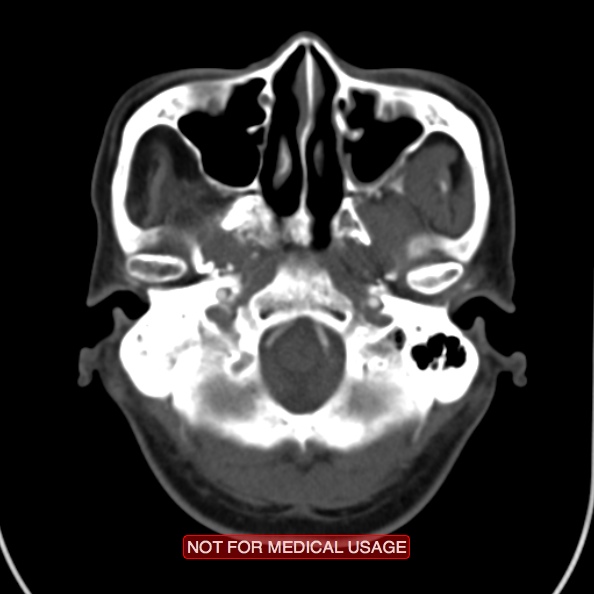 File:Nasopharyngeal carcinoma recurrence - skull base destruction (Radiopaedia 29107-29491 A 8).jpg