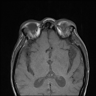 File:Nasopharyngeal carcinoma with skull base invasion (Radiopaedia 59258-66600 B 1).jpg