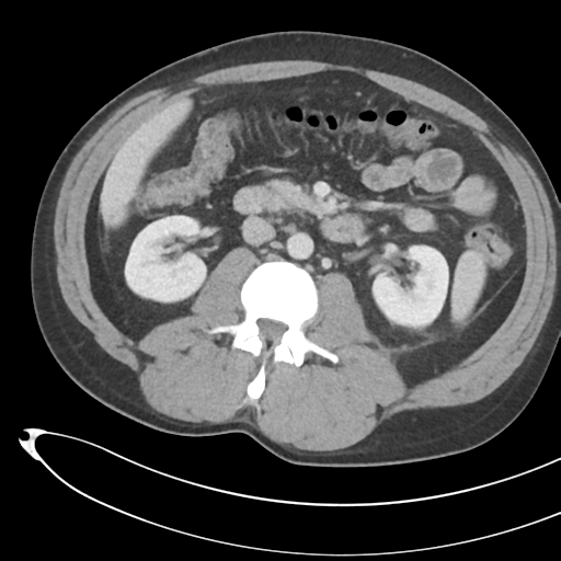 File:Necrotizing pancreatitis with acute necrotic collections (Radiopaedia 38829-41012 B 39).png