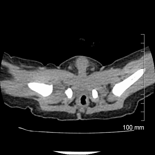 File:Neonatal neuroblastoma (Radiopaedia 56651-63438 Axial non-contrast 83).jpg