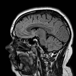 File:Neuro-Behcet's disease (Radiopaedia 21557-21506 Sagittal FLAIR 15).jpg