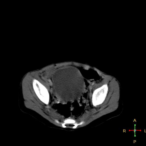 File:Neuroblastoma (Radiopaedia 24751-25016 D 37).jpg