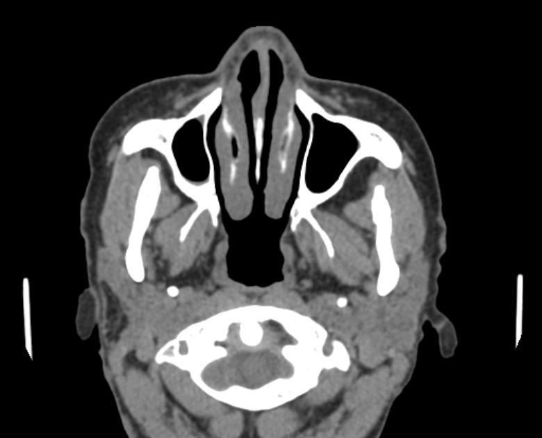 Neurofibromatosis type 1- orbital manifestations (Radiopaedia 49391-54511 Axial non-contrast 20).jpg