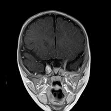 File:Neurofibromatosis type 1 (Radiopaedia 30089-30671 Coronal T1 C+ 10).jpg