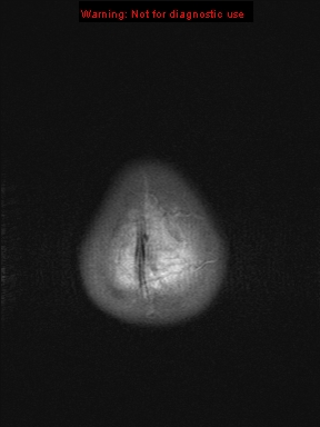 File:Neurofibromatosis type 1 with optic nerve glioma (Radiopaedia 16288-15965 Axial T1 1).jpg