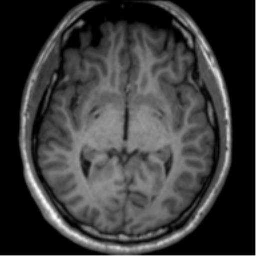 File:Neurofibromatosis type 2 (Radiopaedia 44936-48838 Axial T1 65).png