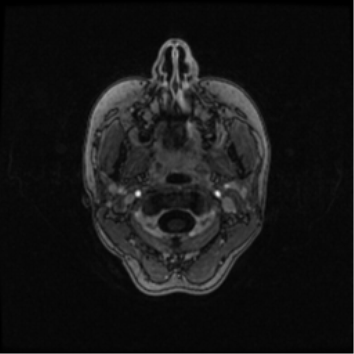 Neurofibromatosis type 2 (Radiopaedia 45229-49244 Axial T1 C+ 13).png
