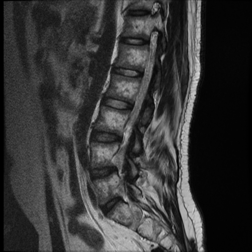File:Neurofibromatosis type 2 (spinal manifestations) (Radiopaedia 53943-60070 E 5).png