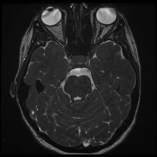 File:Neurofibromatosis type 2 - bilateral acoustic neuromata (Radiopaedia 40060-42566 Axial FIESTA 65).png