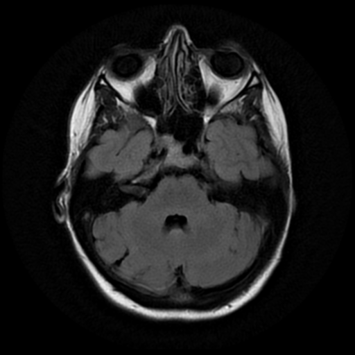 File:Neurofibromatosis type 2 - bilateral acoustic neuromata (Radiopaedia 40060-42566 Axial FLAIR 6).png