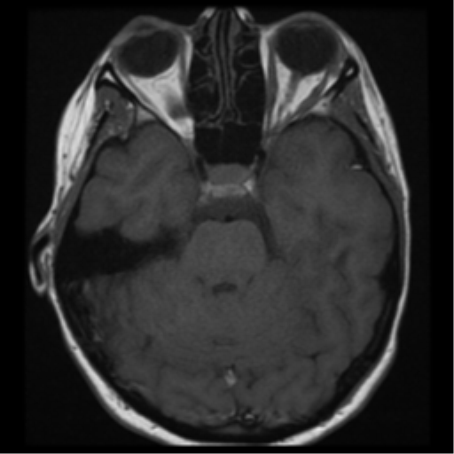 File:Neurofibromatosis type 2 - bilateral acoustic neuromata (Radiopaedia 40060-42566 Axial T1 10).png