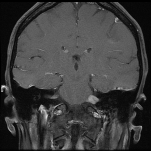 File:Neurofibromatosis type 2 - bilateral acoustic neuromata (Radiopaedia 40060-42566 Coronal T1 C+ 5).png