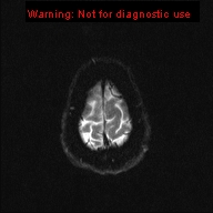 File:Neuroglial cyst (Radiopaedia 10713-11184 Axial DWI 2).jpg