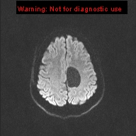 File:Neuroglial cyst (Radiopaedia 10713-11184 Axial DWI 29).jpg