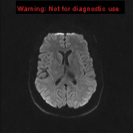 File:Neuroglial cyst (Radiopaedia 10713-11184 Axial DWI 33).jpg