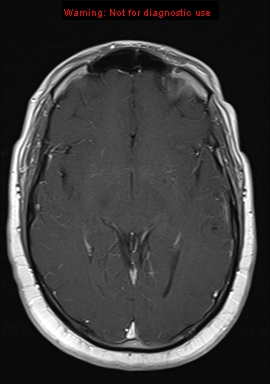 File:Neuroglial cyst (Radiopaedia 10713-11184 Axial T1 C+ 13).jpg