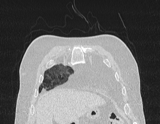Non specific interstitial pneumonia (NSIP) (Radiopaedia 89725-106798 Coronal lung window 11).jpg
