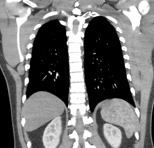 File:Normal CTA thorax (non ECG gated) (Radiopaedia 41750-44704 B 64).png