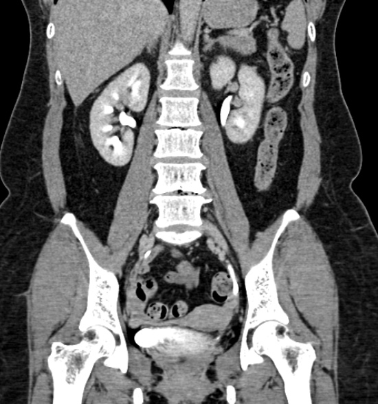 Normal CT intravenous urogram (Radiopaedia 39444-41759 A 290).jpg