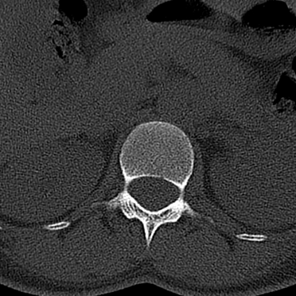 File:Normal CT lumbar spine (Radiopaedia 53981-60118 Axial bone window 14).jpg