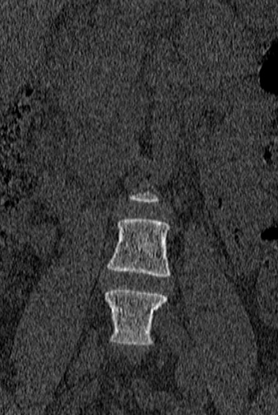 File:Normal CT lumbar spine (Radiopaedia 53981-60118 Coronal bone window 5).jpg