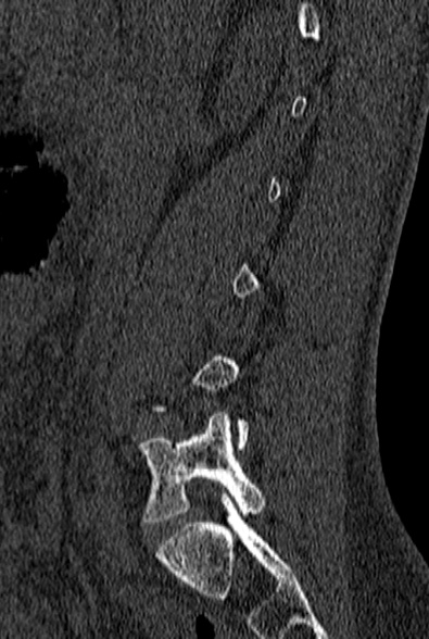 File:Normal CT lumbar spine (Radiopaedia 53981-60118 Sagittal bone window 25).jpg