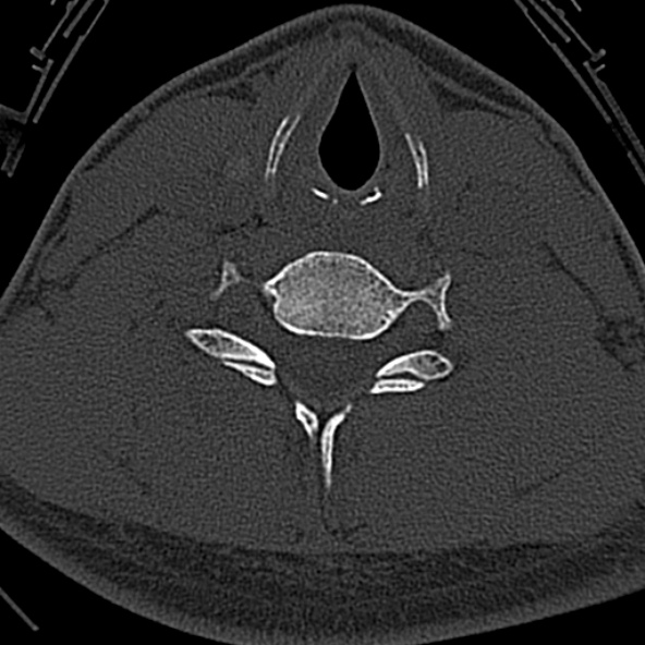 File:Normal CT of the cervical spine (Radiopaedia 53322-59305 Axial bone window 189).jpg