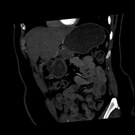 File:Normal CT renal artery angiogram (Radiopaedia 38727-40889 C 2).png