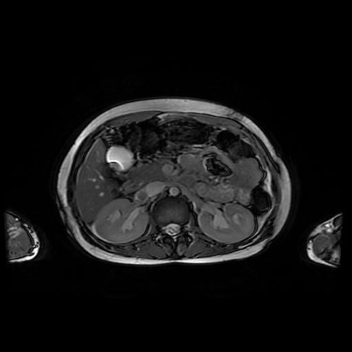 File:Normal MRI abdomen in pregnancy (Radiopaedia 88001-104541 Axial Gradient Echo 18).jpg