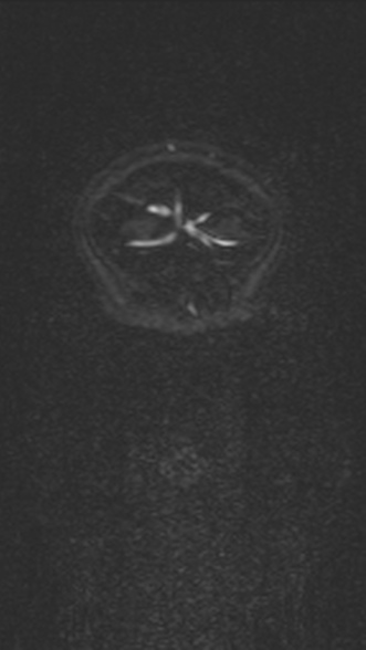 Normal MRI brain with MRV- teenager (Radiopaedia 49425-54553 Coronal MRV 37).jpg