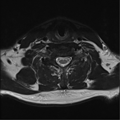 File:Normal MRI cervical spine (infection protocol) (Radiopaedia 53916-60039 Axial T2 36).png