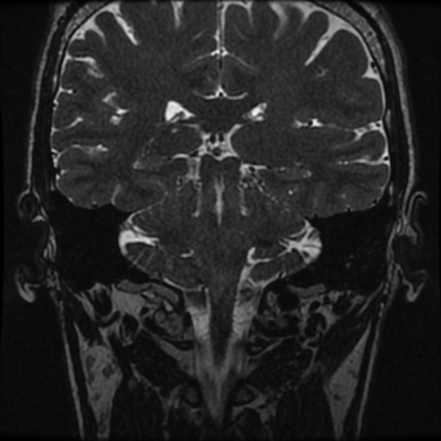 Normal MRI petrous (Radiopaedia 91317-108949 Coronal T2 74).jpg