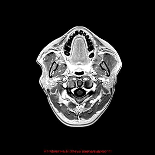Normal adult brain MRI (non-enhanced and contrast-enhanced) (Radiopaedia 75262-86379 Axial T1 C+ 27).jpg