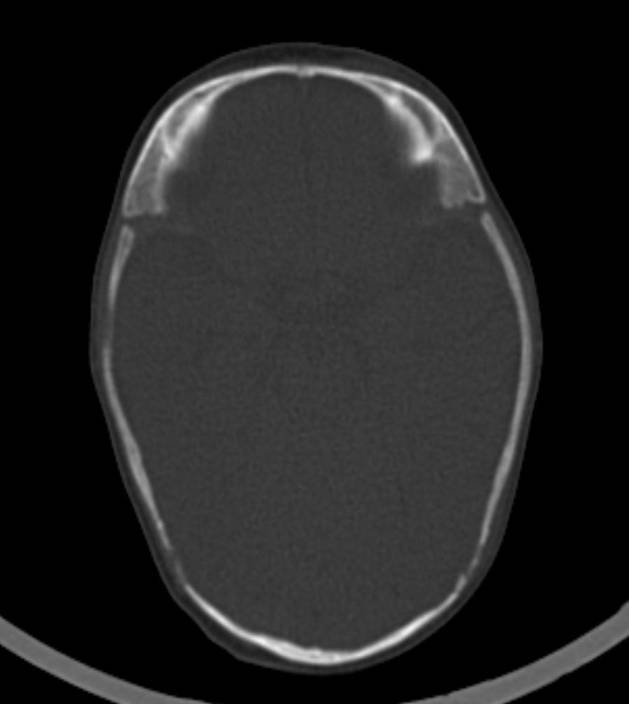 Normal brain CT - 2-month-old (Radiopaedia 53369-59350 Axial bone window 39).jpg