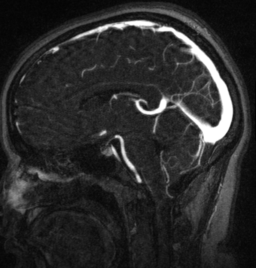 Normal brain MRI and venogram (Radiopaedia 39554-41862 Sagittal MRV 35).jpg