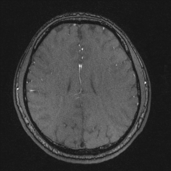 Normal brain MRI including MRA (Radiopaedia 48748-53763 Axial MRA 146).jpg