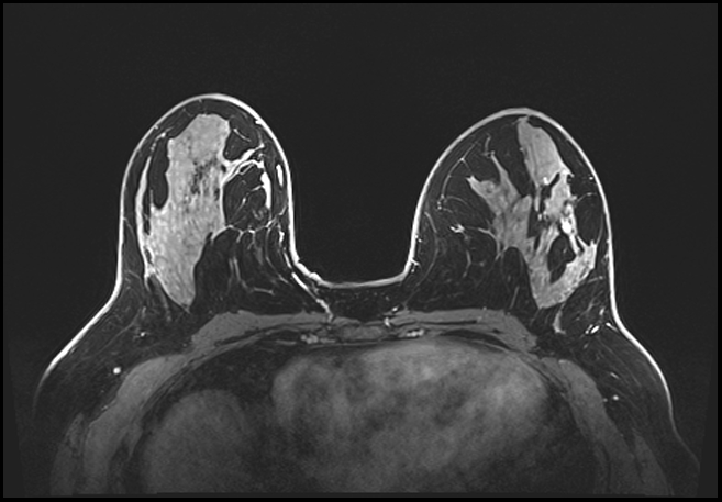 Normal breast MRI - dense breasts (Radiopaedia 80454-93850 C 107).jpg