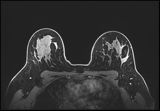 Normal breast MRI - dense breasts (Radiopaedia 80454-93850 C 148).jpg