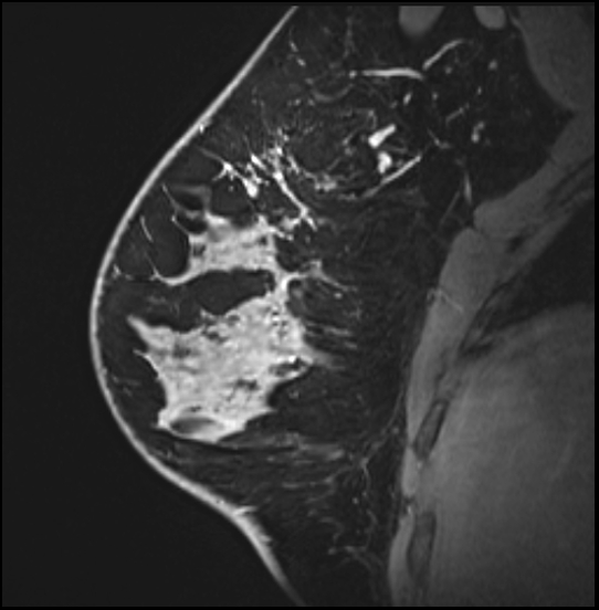 Normal breast MRI - dense breasts (Radiopaedia 80454-93850 I 61).jpg